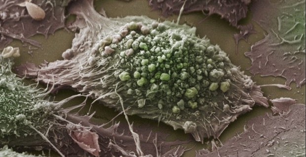 lung cancer cell